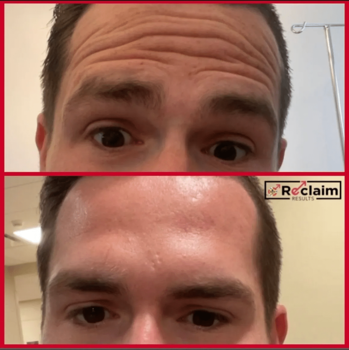 Men Botox Before & After Treatment | Reclaim Men's Clinic in St. Louis, MO