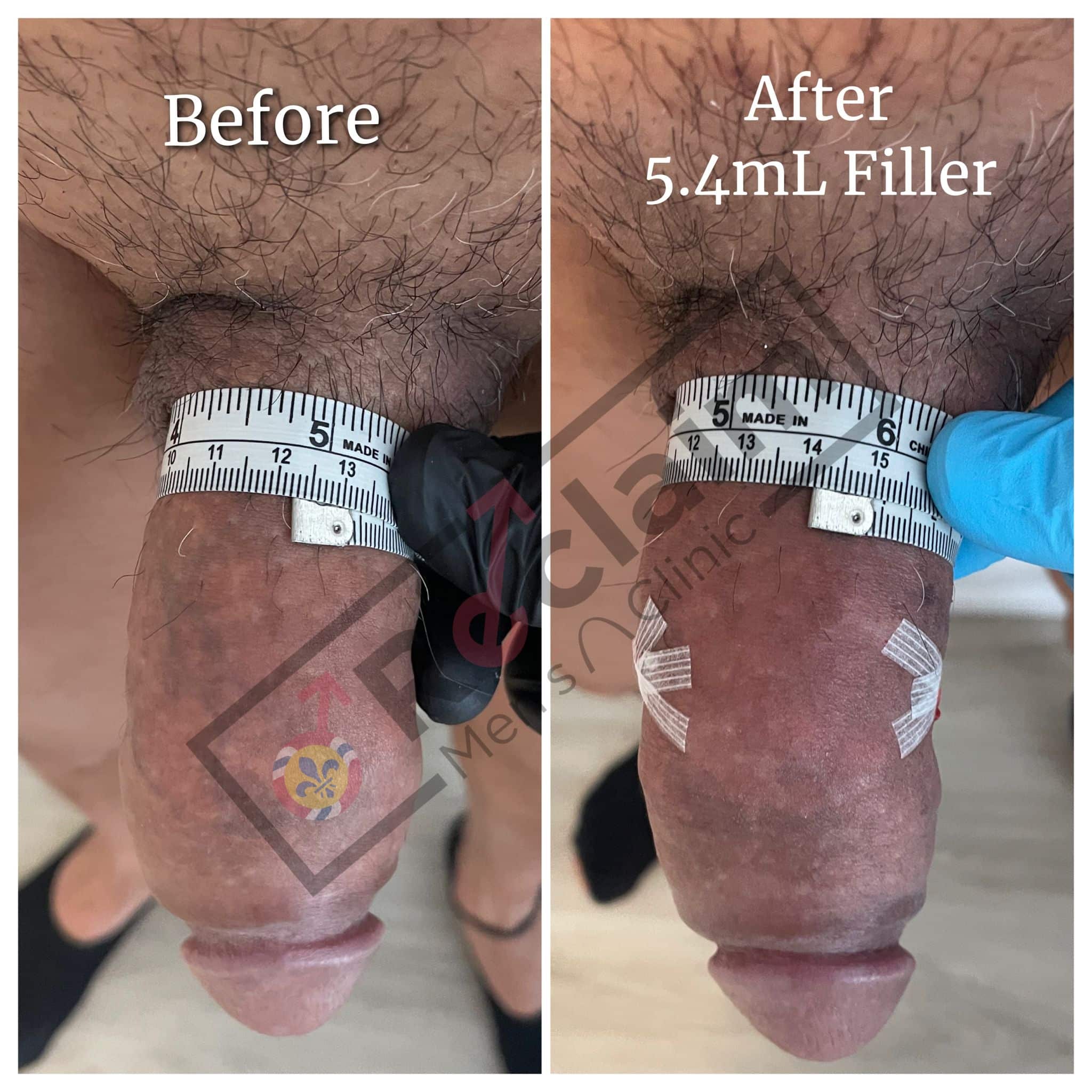 Penile Augmentation Before and After Image | Reclaim Men’s Clinic