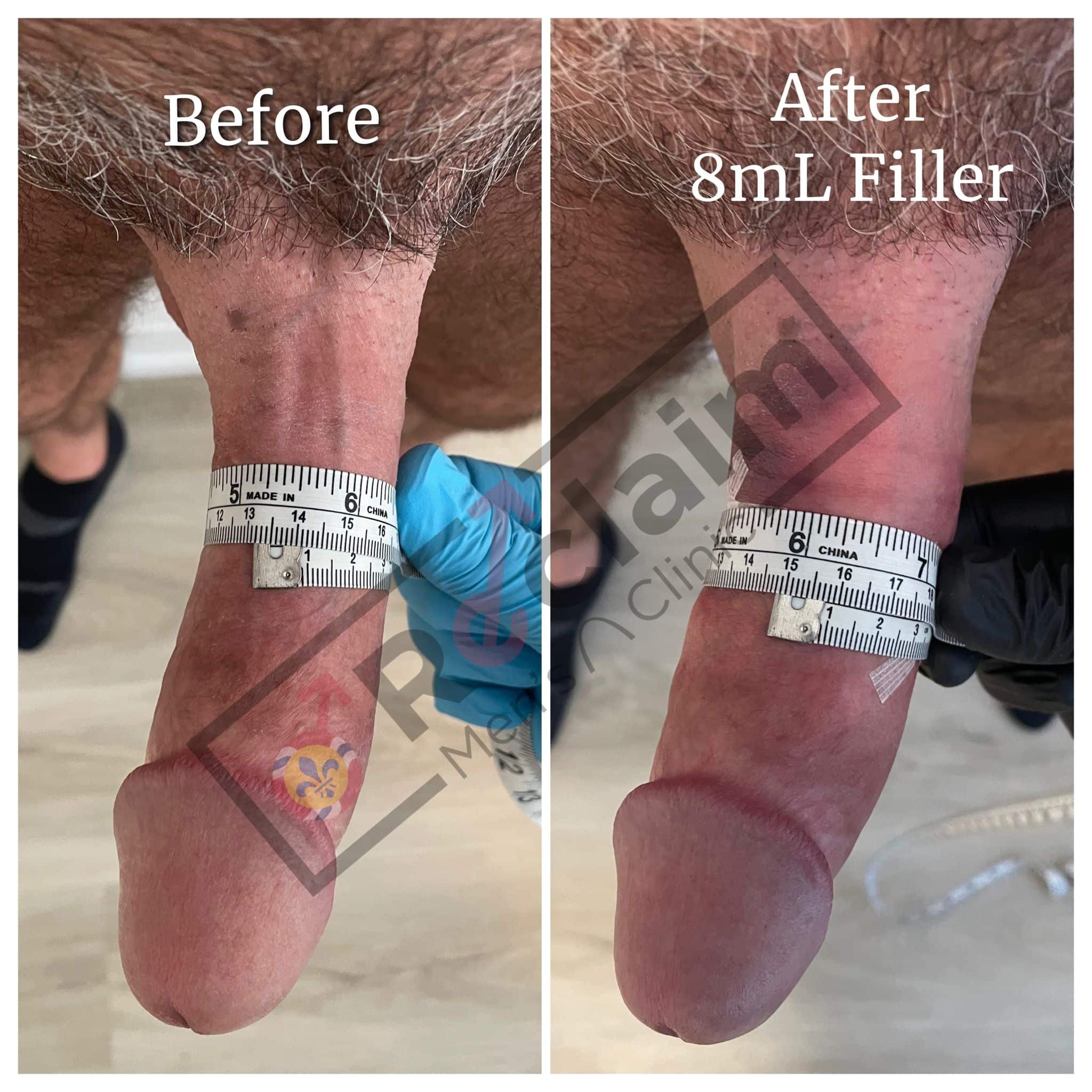 Penile Augmentation Before and After Image | Reclaim Men’s Clinic