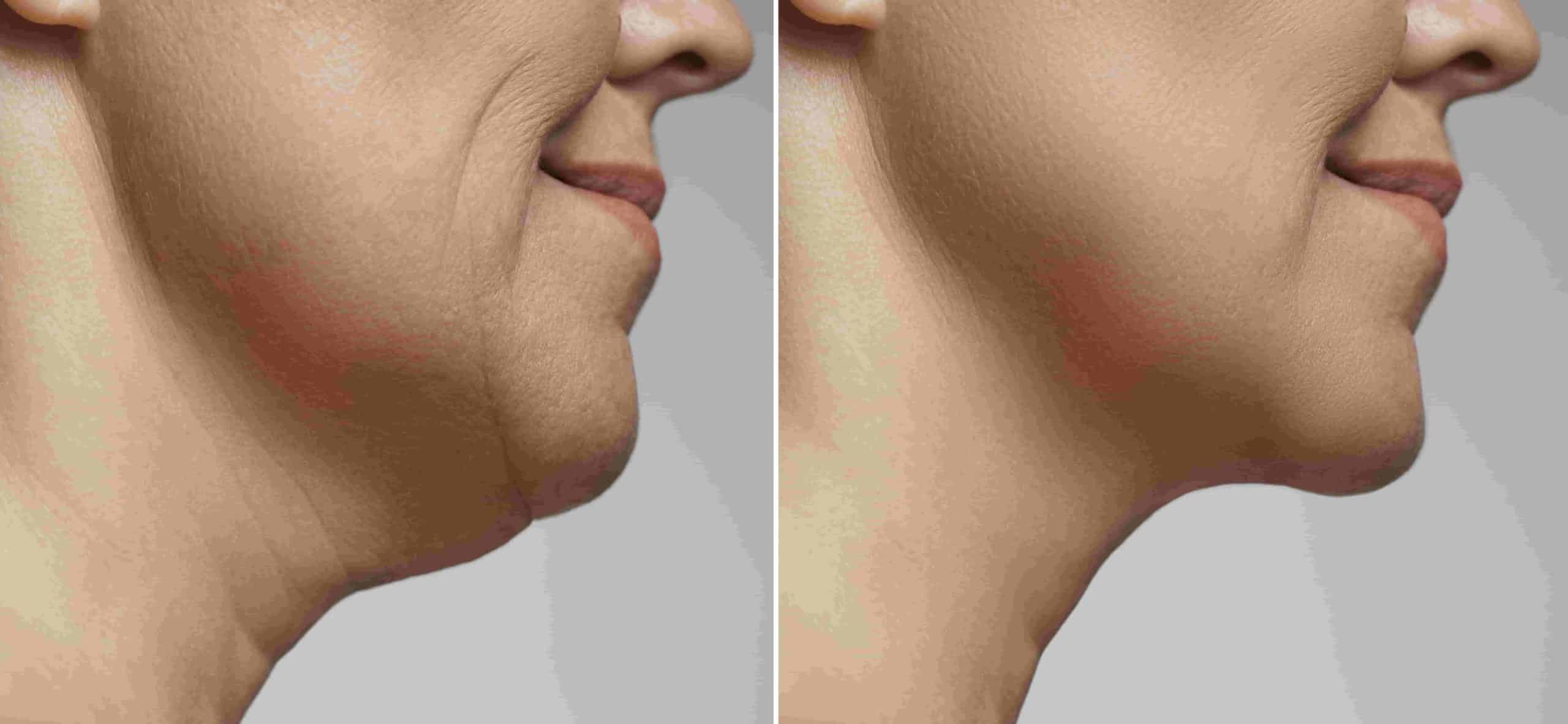Enhancing Your Jawline and Chin Exploring Techniques and Benefits